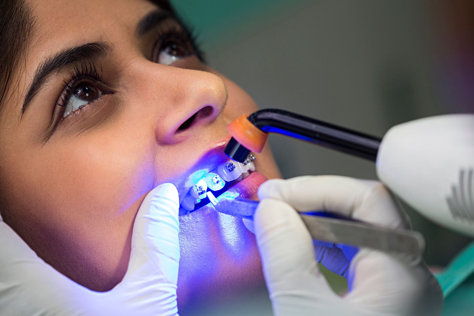 Braces & Aligners