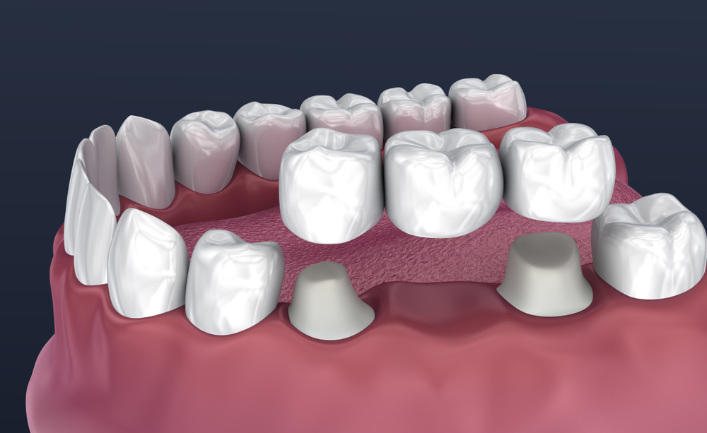 Crown and Bridge Treatment